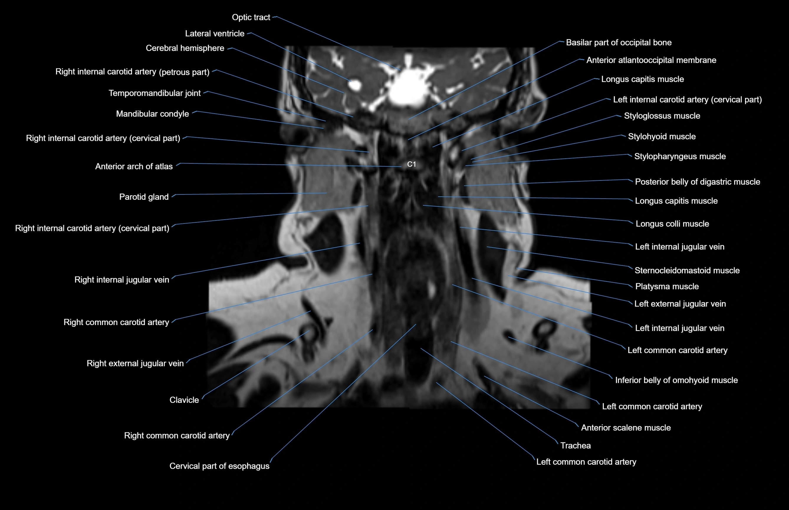 Neck coronal cross sectional MRI anatomy 3T MRI  image-img-00001-00036.webp
